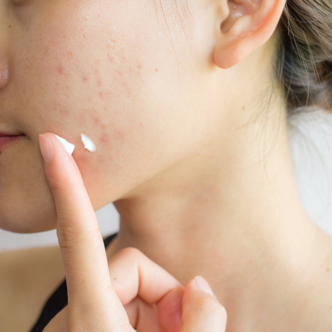 Our Favorite Ingredients and Treatments for Acne