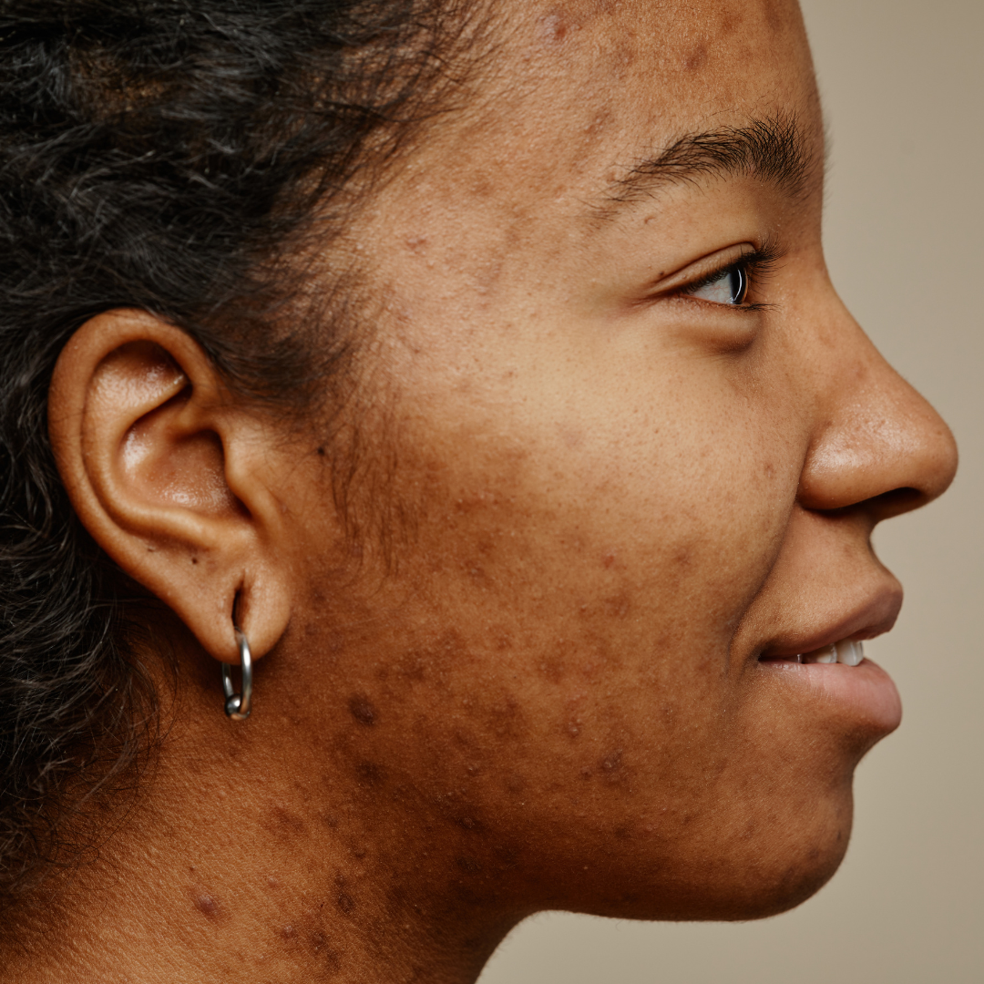 Understanding Acne, the Skin Barrier, and the Microbiome