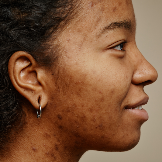 Understanding Acne, the Skin Barrier, and the Microbiome