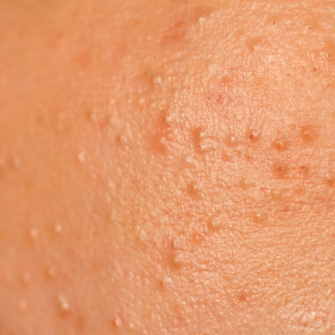 Understanding Acne Triggers and How to Combat Them