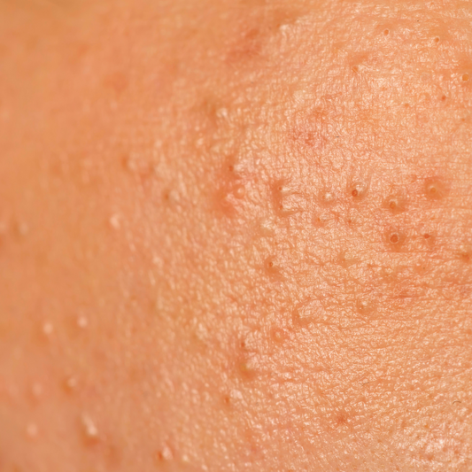 Understanding Acne Triggers and How to Combat Them