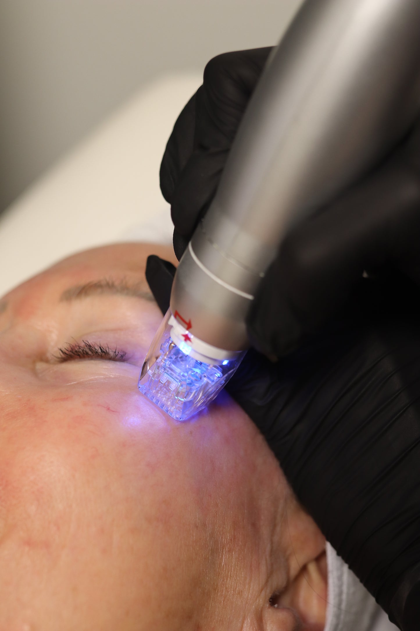 RF Microneedling - Face & Neck
