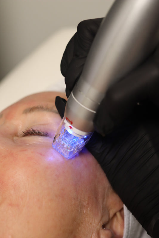RF Microneedling - Face & Neck