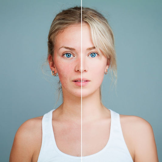 Anti-Redness Laser Facial