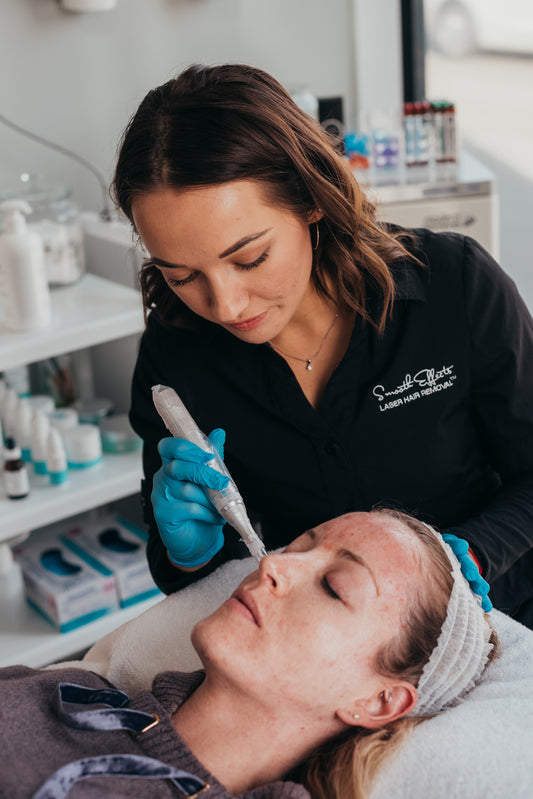 Microneedling - Face
