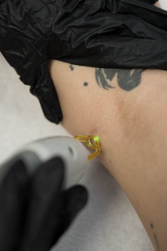 How to get rid of spider veins and vascular lesions