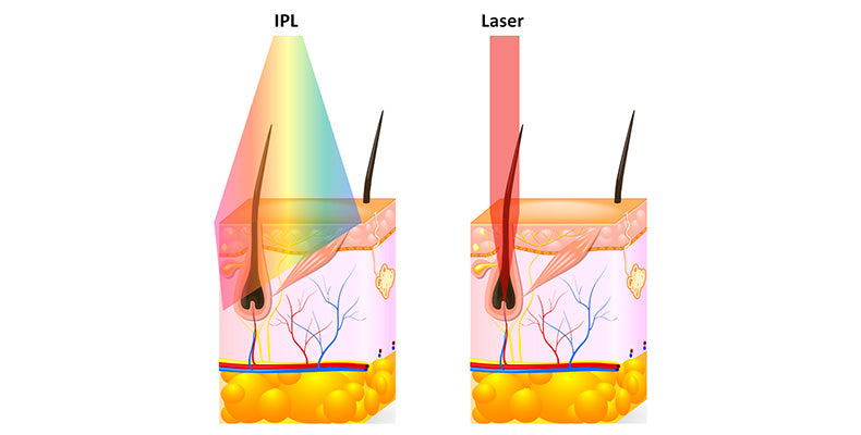 Laser vs. IPL Hair Removal