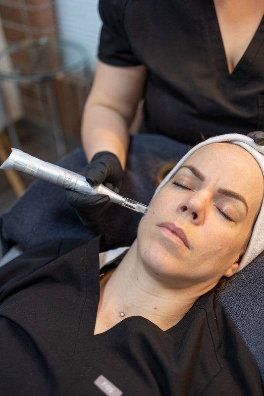 Exosome Microneedling
